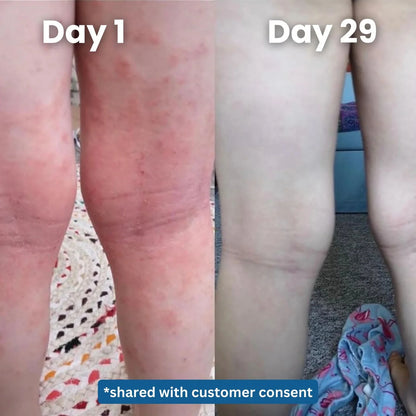 EczemaOcean® Eczema Relief Cream
