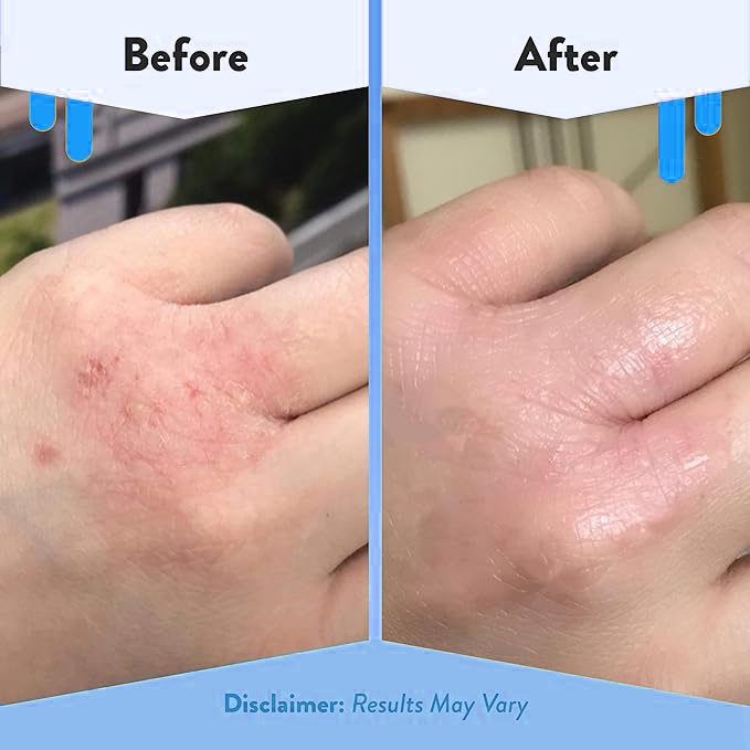 EczemaOcean® Eczema Relief Cream