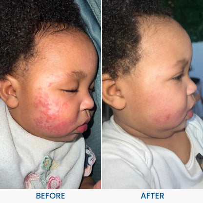 EczemaOcean® Eczema Relief Cream